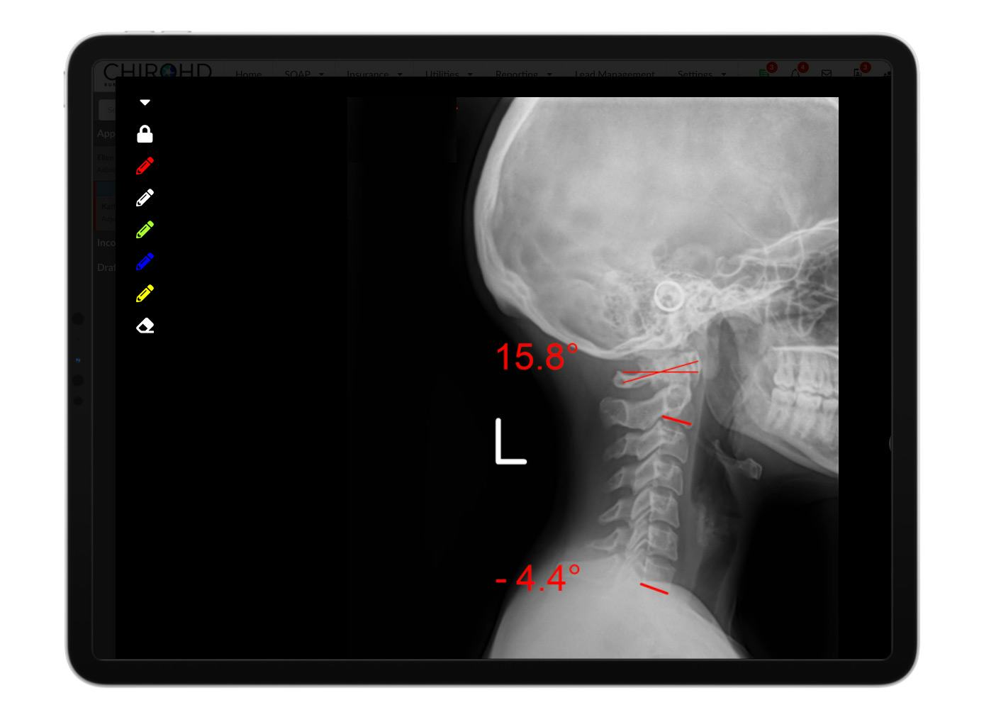 ChiroHD Software - 4