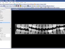 Open Dental Software - Imaging Module. Used to manage patient pictures, documents, and take X-Rays.  Image displays example of bitewing X-Ray.