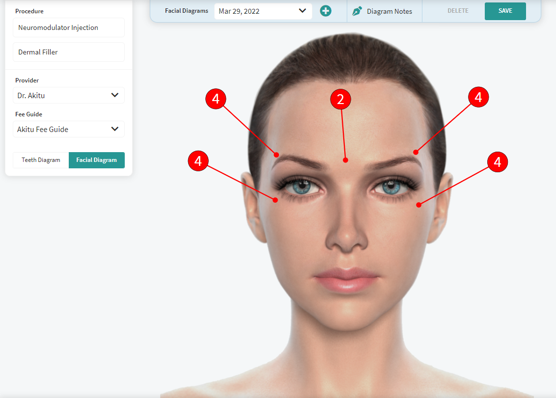 Facial Charting can be used for Botox and Dermal Filler Charting