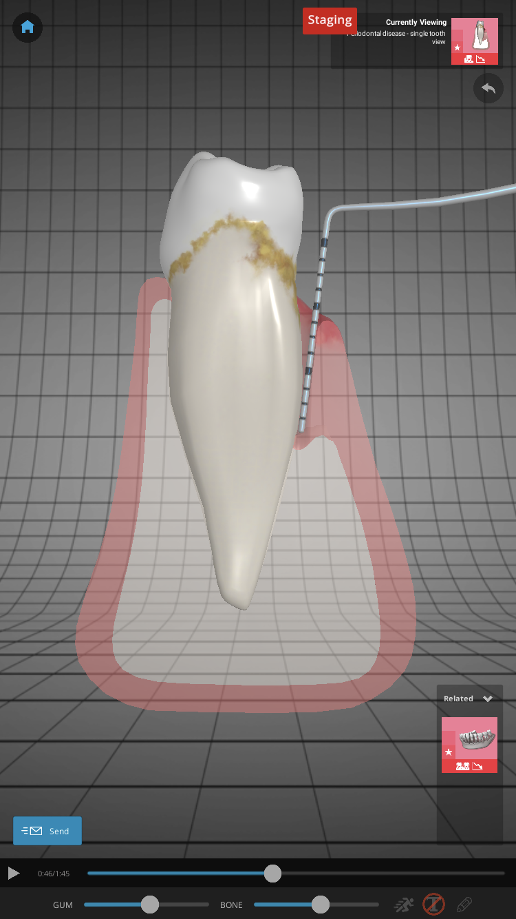 Chapter2Dental screenshot: Chapter2Dental easy to explain periodontal disease
