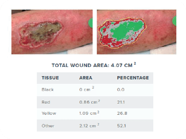 Net Health Tissue Analytics - wound measurement