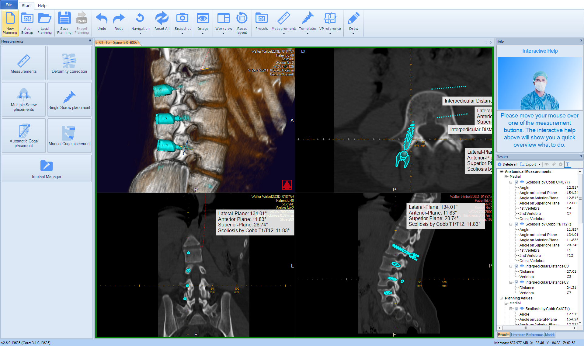3D Spine Scre Placement