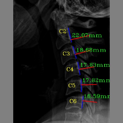 Measuring of cervical spine by SpindleX