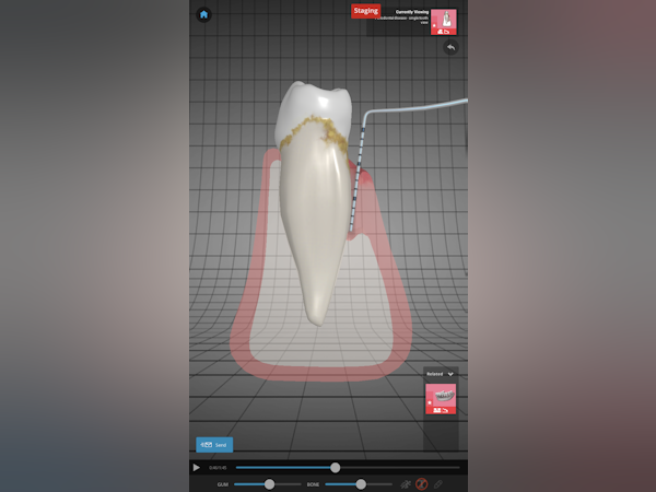 Chapter2Dental Software - Easy to explain periodontal disease