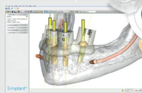 SimPlant GO screenshot: SimPlant GO computer guided treatment