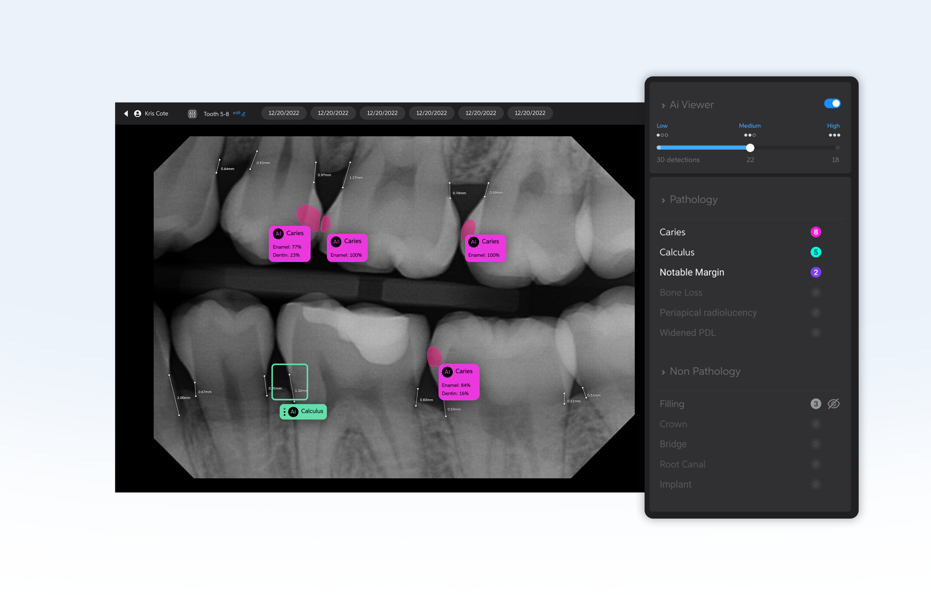Pearl's Second Opinion real-time dental AI software provides an industry-leading range of FDA-cleared detection capabilities.