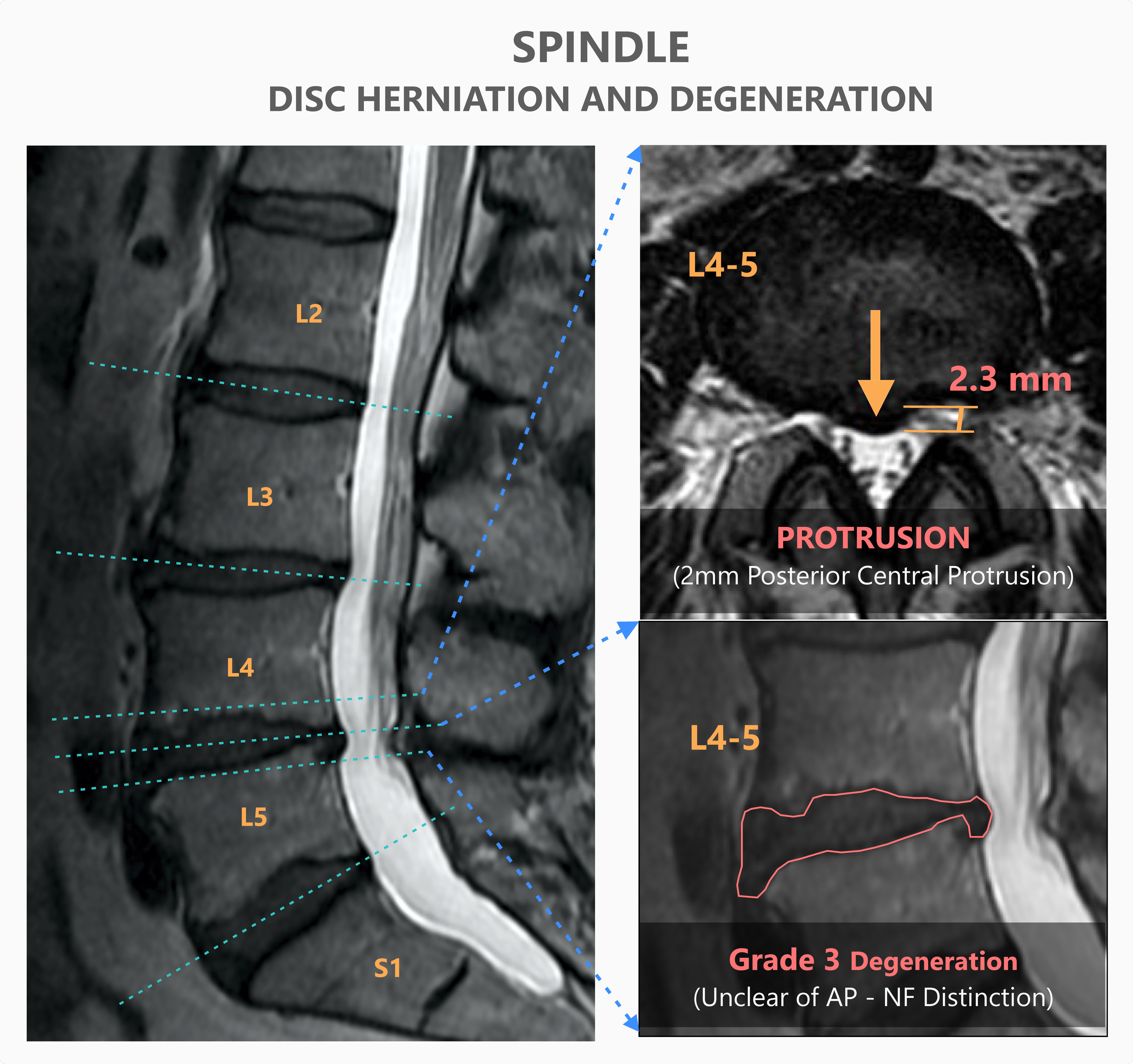 Grading of Spine degeneration and Measuring the extent of protrusion by Spindle