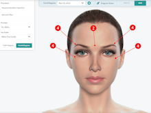 Akitu One Software - Facial Charting can be used for Botox and Dermal Filler Charting