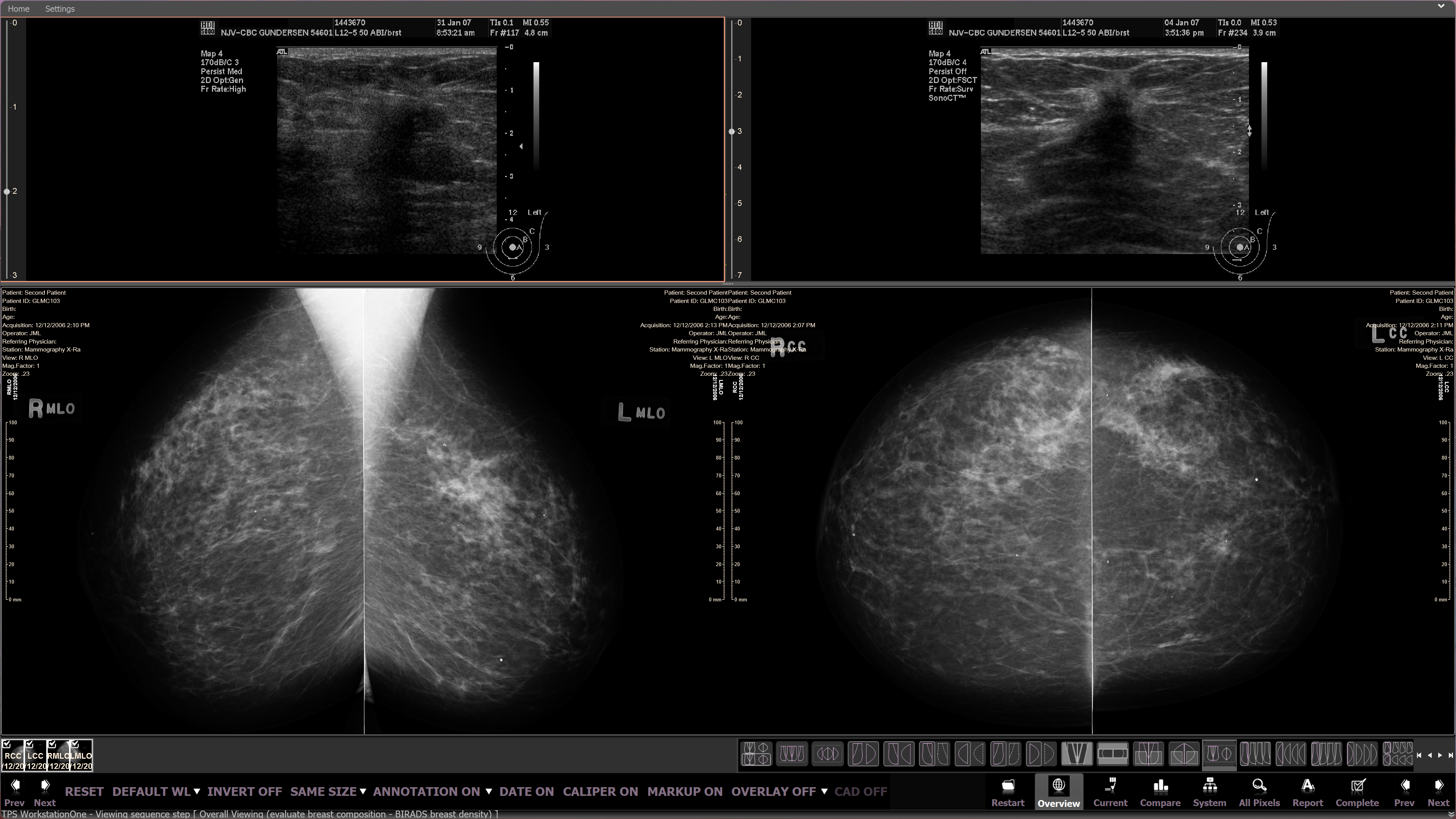 Large high-resolution (12MP) monitor partitioned to show mammography simultaneous with viewers for related modalities.