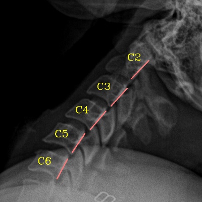 Labeling of cervical spine levels by SpindleX