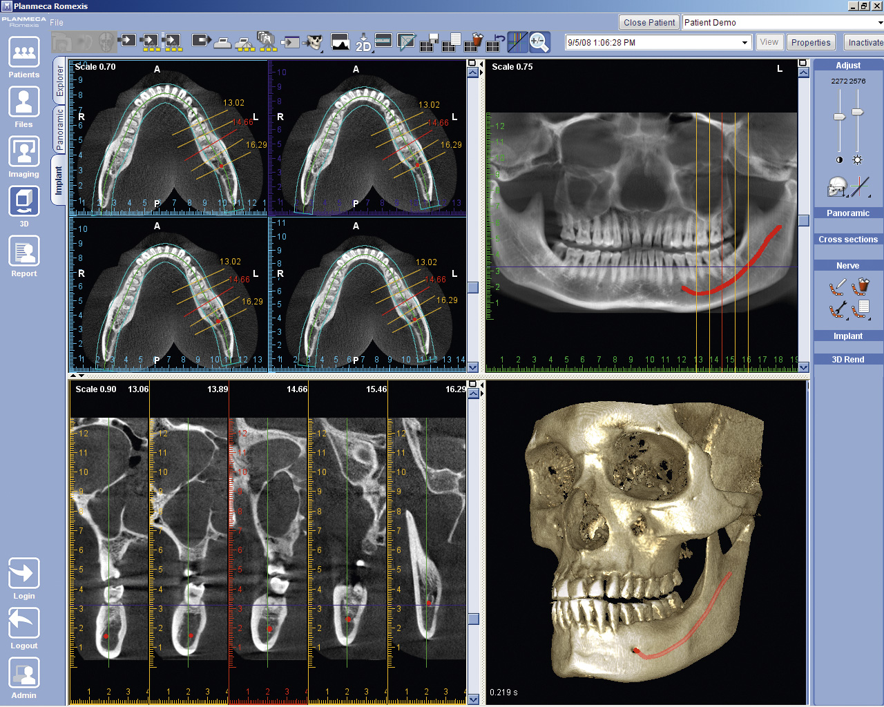 3D implant viewer 2
