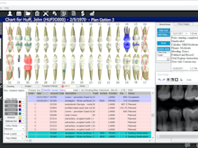 DentiMax Software - DentiMax Treatment Planning Screen