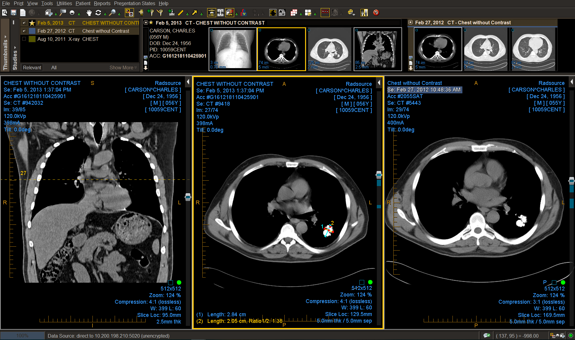 Chest CT with prior study comparison