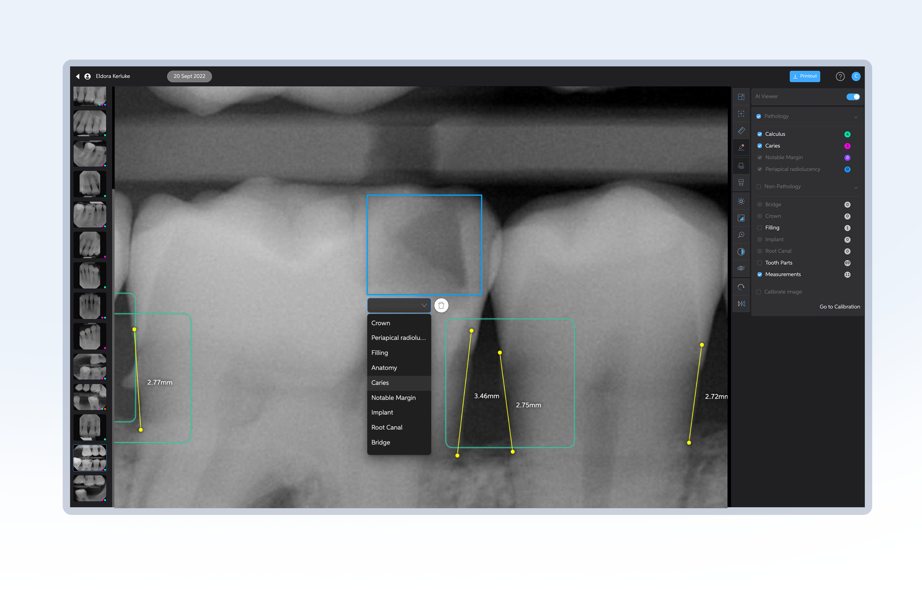 Pearl's Second Opinion real-time dental AI software features a robust range of image adjustment and custom annotation tools to ensure that patients can clearly see and understand their x-rays.
